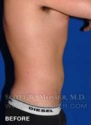 Liposuction - Abdomen & Flanks Patient 25141 Before Photo Thumbnail # 7