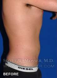 Liposuction - Abdomen & Flanks Patient 25141 Before Photo # 7