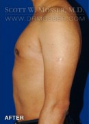 Liposuction - Chest Patient 51091 After Photo Thumbnail # 4