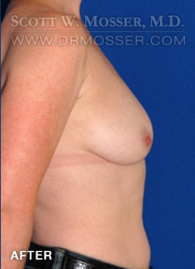 Breast Reduction Patient 98001 After Photo # 6