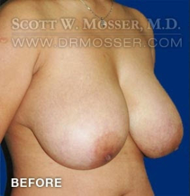 Breast Reduction Patient 54903 Before Photo # 5