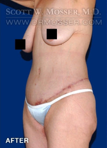 Lower Body Lift Patient 68424 After Photo # 6
