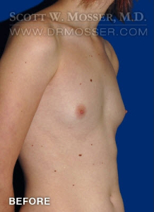 Breast Augmentation Patient 21498 Before Photo # 3