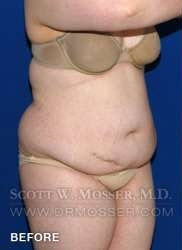 Liposuction - Abdomen & Flanks Patient 26351 Before Photo # 3