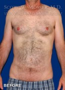 Liposuction - Abdomen & Flanks Patient 23232 Before Photo Thumbnail # 7