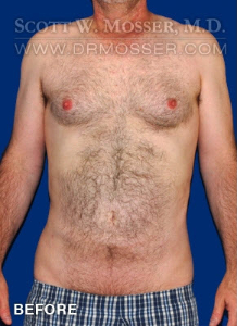 Liposuction - Abdomen & Flanks Patient 23232 Before Photo # 7