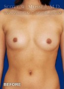 Breast Augmentation Patient 85660 Before Photo Thumbnail # 1