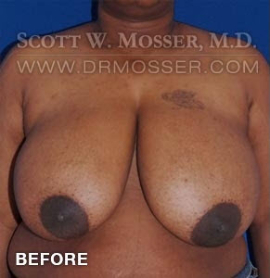 Breast Reduction Patient 91361 Before Photo # 1