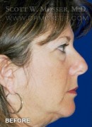 Upper Blepharoplasty Patient 20934 Before Photo Thumbnail # 1