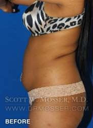 Liposuction - Abdomen & Flanks Patient 41506 Before Photo # 9