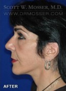 Chin Implant Patient 91901 After Photo Thumbnail # 4