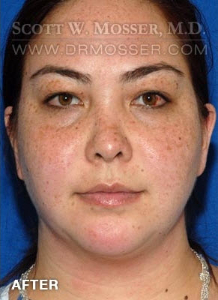 Chin Implant Patient 69285 After Photo # 2