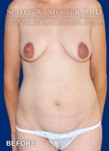 Mommy Makeover Patient 38394 Before Photo # 1