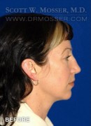 Upper Blepharoplasty Patient 81608 Before Photo Thumbnail # 5
