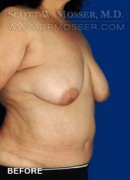 Breast Reduction Patient 54296 Before Photo Thumbnail # 3