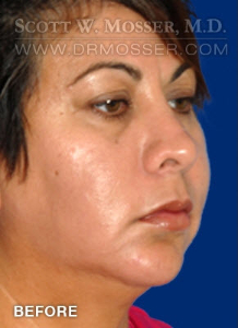 Chin Implant Patient 68063 Before Photo # 3
