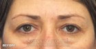 Lower Blepharoplasty Patient 88372 Before Photo Thumbnail # 1