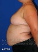 Breast Reduction Patient 24410 After Photo Thumbnail # 10