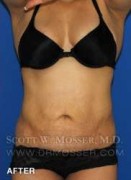 Liposuction - Abdomen & Flanks Patient 30590 After Photo Thumbnail # 2