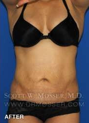 Liposuction - Abdomen & Flanks Patient 30590 After Photo # 2