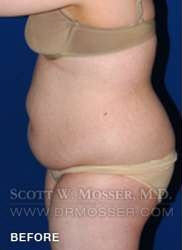 Liposuction - Abdomen & Flanks Patient 26351 Before Photo # 7