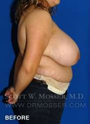 Breast Reduction Patient 27332 Before Photo # 5