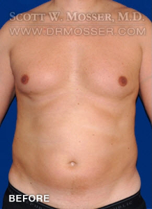 Liposuction - Chest Patient 10587 Before Photo # 1