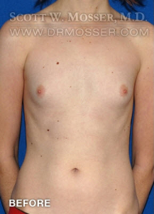 Breast Augmentation Patient 21498 Before Photo # 1
