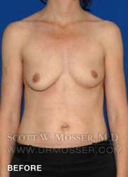 Breast Asymmetry Correction Patient 37996 Before Photo # 1