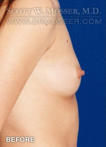 Breast Augmentation Patient 84593 Before Photo # 5