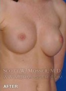 Nipple Inversion Correction Patient