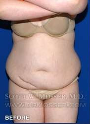 Liposuction - Abdomen & Flanks Patient 26351 Before Photo # 1