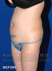 Liposuction - Abdomen & Flanks Patient 81638 Before Photo # 5
