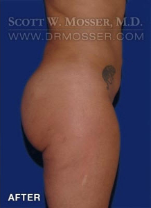 Brazilian Butt Lift Patient 32708 After Photo # 2