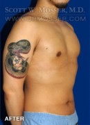 Liposuction - Chest Patient 38439 After Photo Thumbnail # 4
