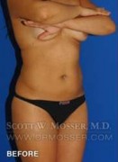 Liposuction - Abdomen & Flanks Patient 33709 Before Photo Thumbnail # 3