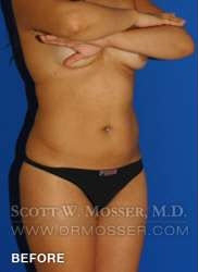 Liposuction - Abdomen & Flanks Patient 33709 Before Photo # 3