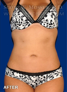 Liposuction - Thighs Patient 23539 After Photo # 2