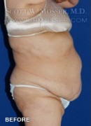 Abdominoplasty Patient 72192 Before Photo Thumbnail # 3