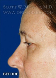 Lower Blepharoplasty Patient 38290 Before Photo # 3