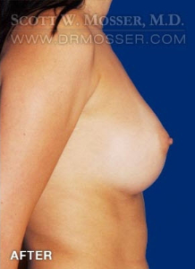 Breast Augmentation Patient 24873 After Photo # 6