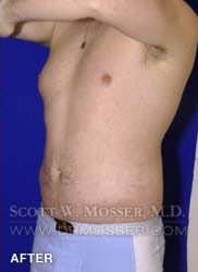 Liposuction - Abdomen & Flanks Patient 25141 After Photo # 6