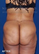 Lower Body Lift Patient 16603 After Photo Thumbnail # 8