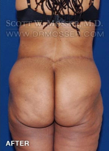 Lower Body Lift Patient 16603 After Photo # 8