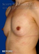 Breast Augmentation Patient 51986 Before Photo Thumbnail # 3