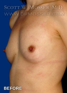 Breast Augmentation Patient 51986 Before Photo # 3