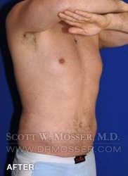 Liposuction - Abdomen & Flanks Patient 25141 After Photo # 4