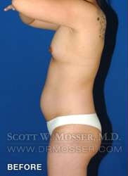 Liposuction - Thighs Patient 89876 Before Photo # 1