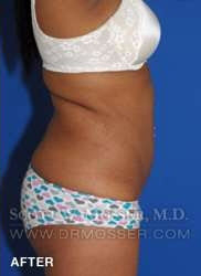 Liposuction - Abdomen & Flanks Patient 41506 After Photo # 8