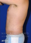 Liposuction - Abdomen & Flanks Patient 25141 After Photo Thumbnail # 10